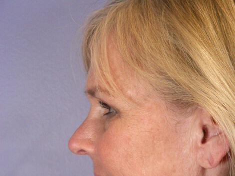 Laser Skin Resurfacing Gallery Before & After Image