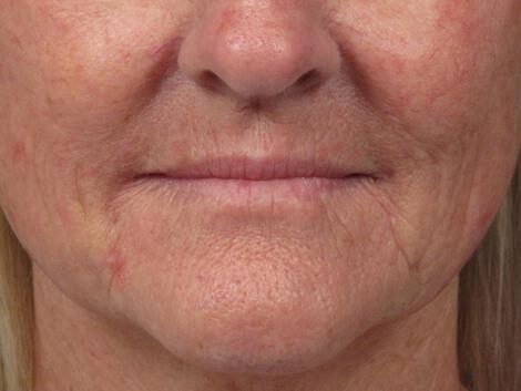 Laser Skin Resurfacing Gallery Before & After Image