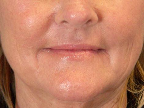 Laser Skin Resurfacing Gallery Before & After Image