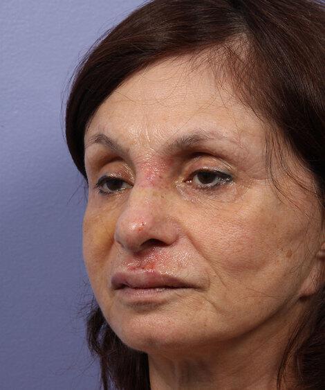 Laser Skin Resurfacing Gallery Before & After Image