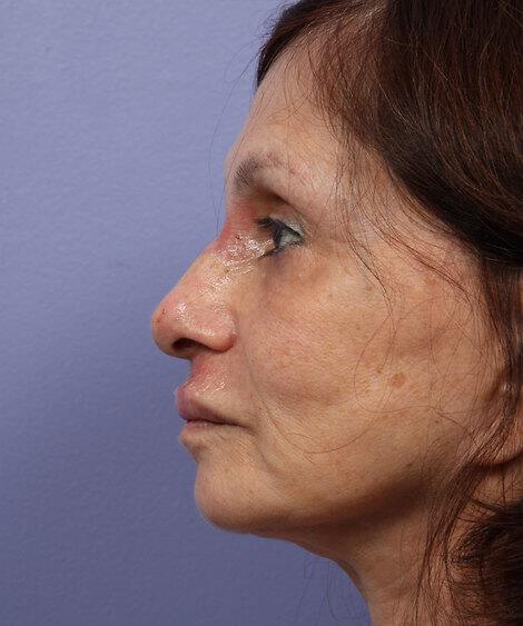 Laser Skin Resurfacing Gallery Before & After Image