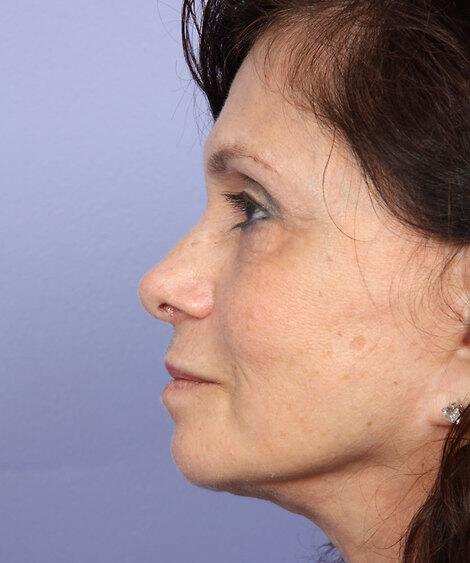 Laser Skin Resurfacing Gallery Before & After Image