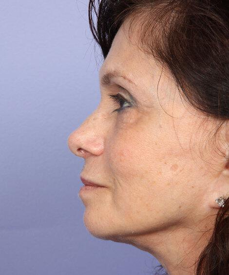 Laser Skin Resurfacing Gallery Before & After Image