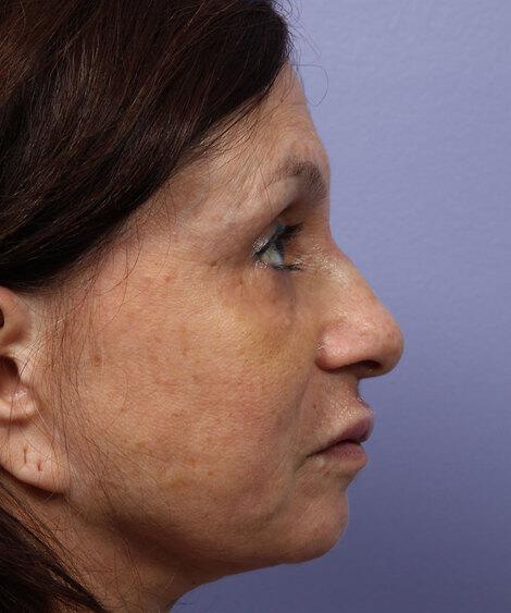 Laser Skin Resurfacing Gallery Before & After Image