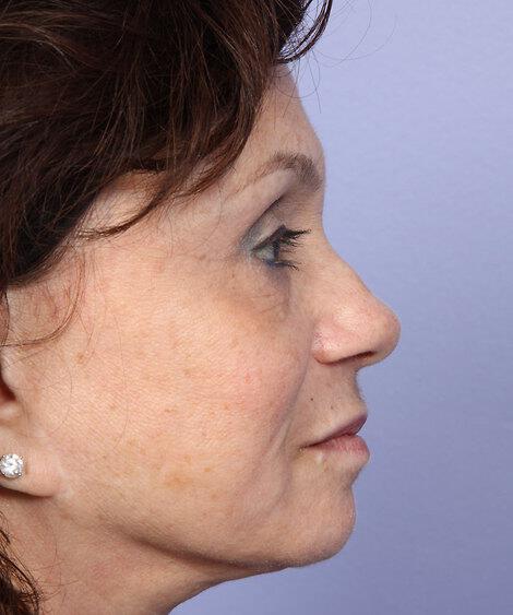 Laser Skin Resurfacing Gallery Before & After Image