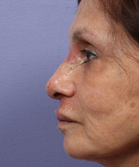 Laser Skin Resurfacing Gallery Before & After Image