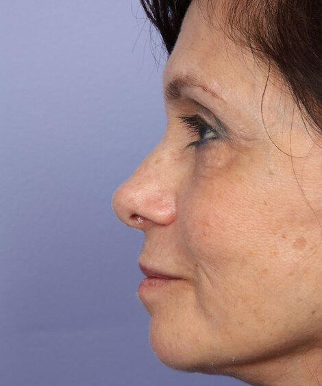 Laser Skin Resurfacing Gallery Before & After Image