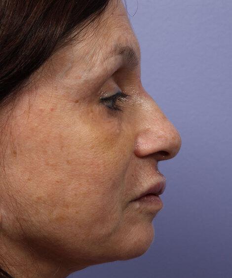 Laser Skin Resurfacing Gallery Before & After Image