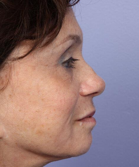 Laser Skin Resurfacing Gallery Before & After Image