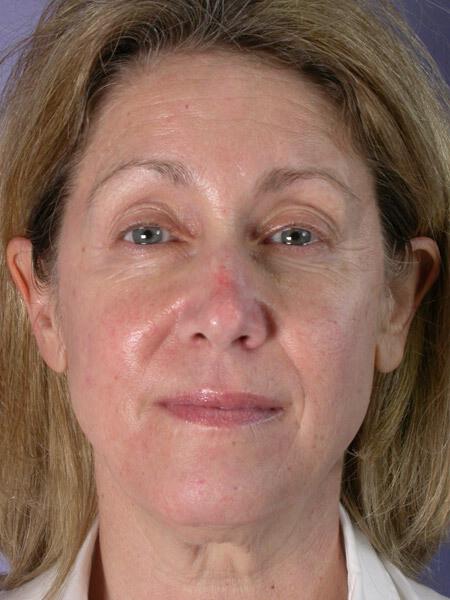 Laser Skin Resurfacing Gallery Before & After Image