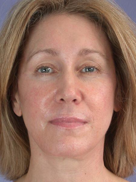 Laser Skin Resurfacing Gallery Before & After Image