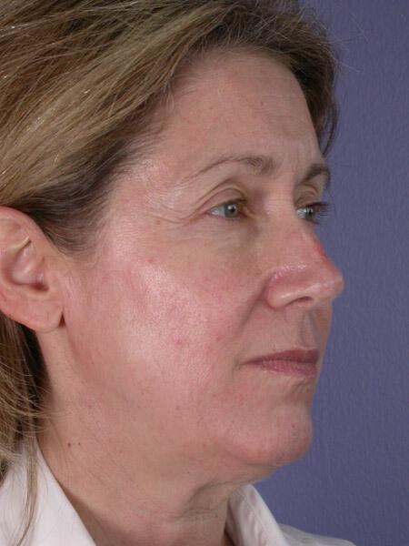 Laser Skin Resurfacing Gallery Before & After Image