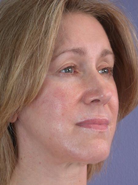 Laser Skin Resurfacing Gallery Before & After Image