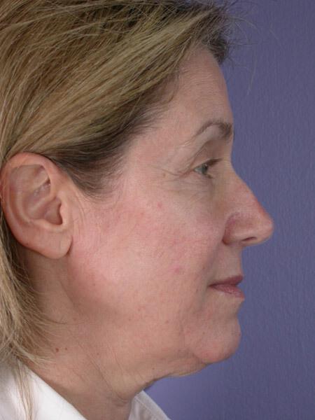 Laser Skin Resurfacing Gallery Before & After Image