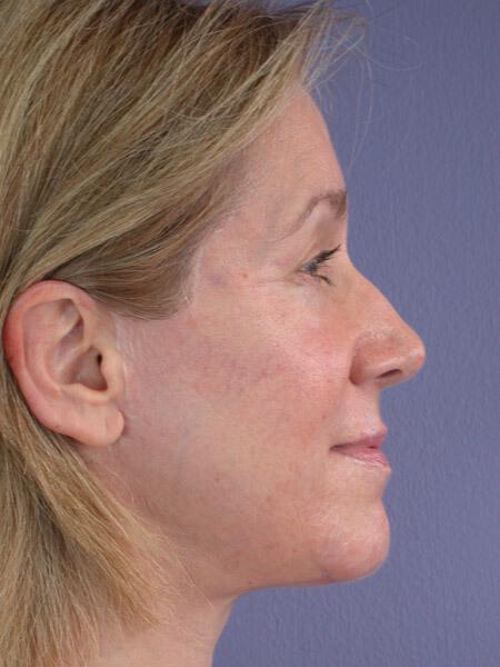 Laser Skin Resurfacing Gallery Before & After Image