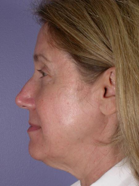 Laser Skin Resurfacing Gallery Before & After Image