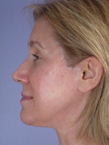 Laser Skin Resurfacing Gallery Before & After Image