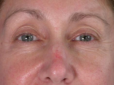 Laser Skin Resurfacing Gallery Before & After Image