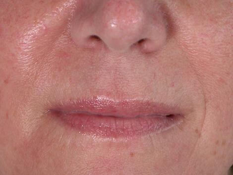 Laser Skin Resurfacing Gallery Before & After Image