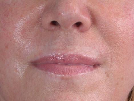 Laser Skin Resurfacing Gallery Before & After Image