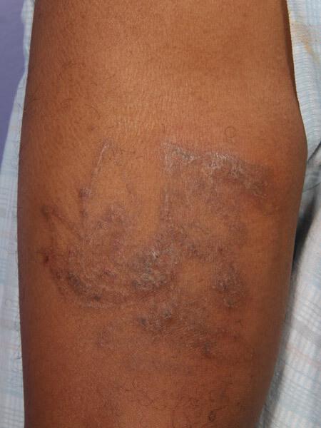Scar Treatment Gallery Before & After Image