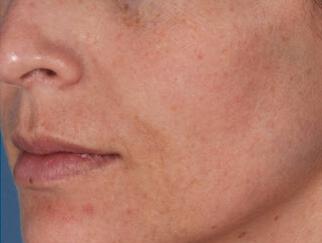 Skin Care Gallery Before & After Image