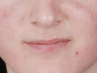 Skin Care Gallery Before & After Image