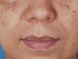 Skin Care Gallery Before & After Image