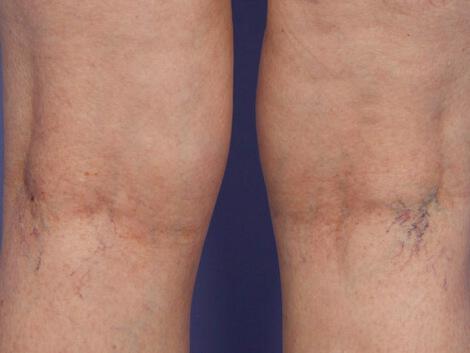 Vein Treatment Gallery Before & After Image