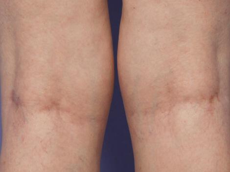 Vein Treatment Gallery Before & After Image