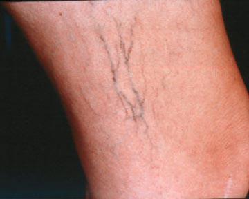 Vein Treatment Gallery Before & After Image