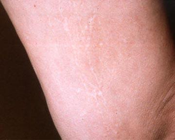 Vein Treatment Gallery Before & After Image