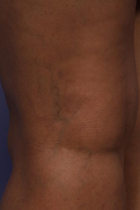 Vein Treatment Gallery Before & After Image