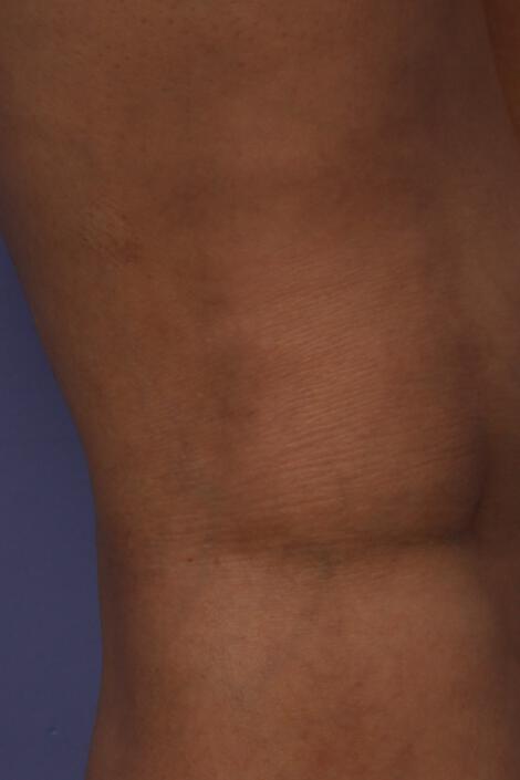 Vein Treatment Gallery Before & After Image