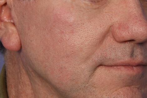 Vein Treatment Gallery Before & After Image