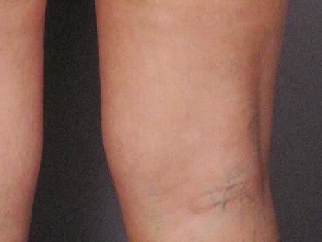 Vein Treatment Gallery Before & After Image