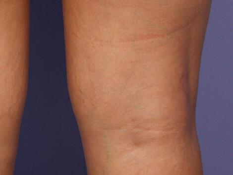 Vein Treatment Gallery Before & After Image