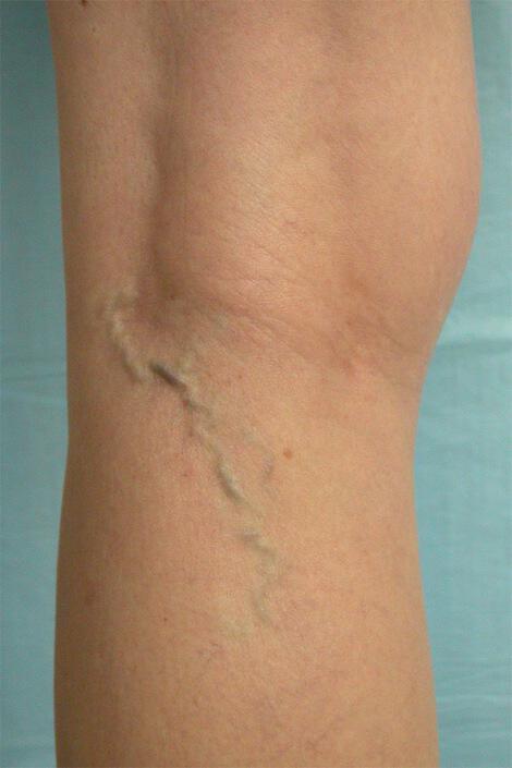 Vein Treatment Gallery Before & After Image