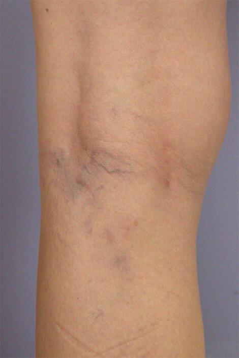Vein Treatment Gallery Before & After Image