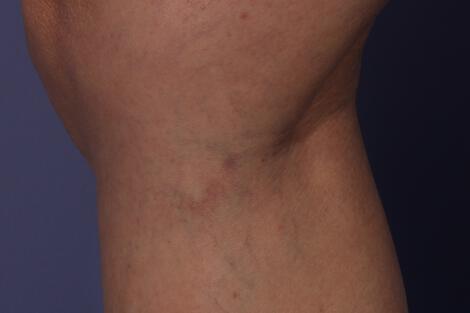 Vein Treatment Gallery Before & After Image