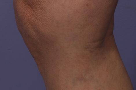 Vein Treatment Gallery Before & After Image