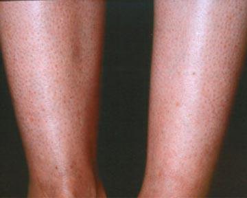 Vein Treatment Gallery Before & After Image