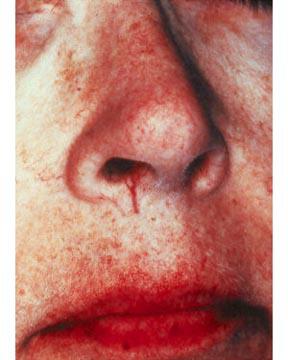 Vein Treatment Gallery Before & After Image
