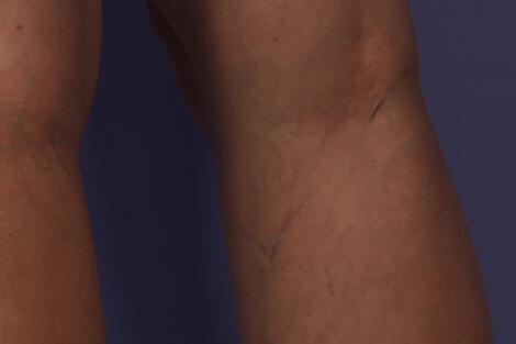 Vein Treatment Gallery Before & After Image