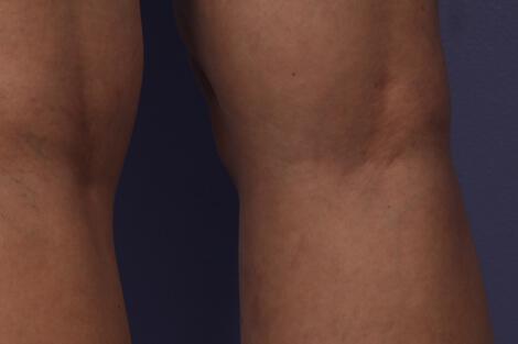 Vein Treatment Gallery Before & After Image