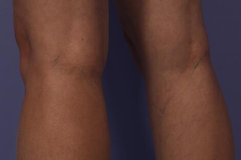 Vein Treatment Gallery Before & After Image