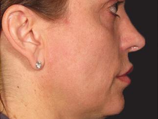 Skin Tightening Gallery Before & After Image