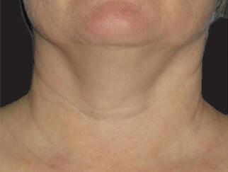 Skin Tightening Gallery Before & After Image