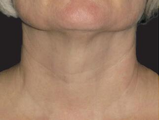 Skin Tightening Gallery Before & After Image