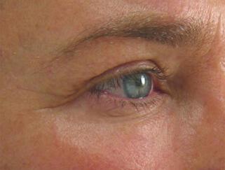 Skin Tightening Gallery Before & After Image